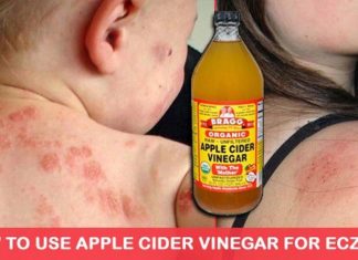 Use Apple Cider Vinegar To Treat Eczema