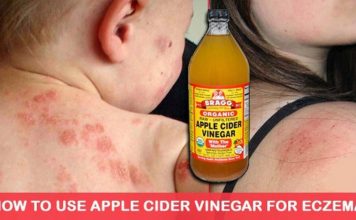Use Apple Cider Vinegar To Treat Eczema